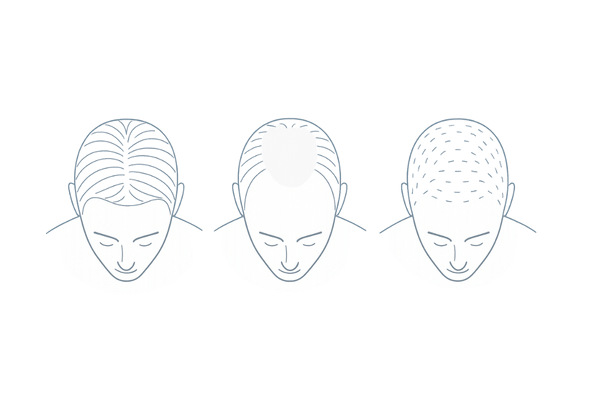 つむじはげと全体的な薄毛の進行パターン比較図（頭頂部・AGAの違い）