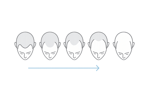 ハミルトン・ノーウッド分類（I〜VII）簡略図