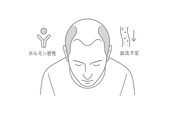 M字生え際が改善しにくい理由（生物学的要因の可視化）