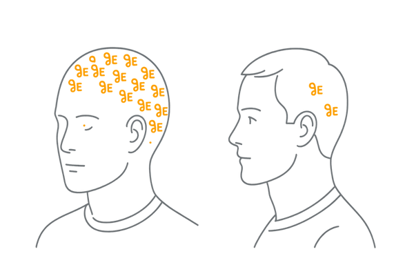 5αリダクターゼ分布：前頭部・頭頂部に多い理由（I型/II型の概念図）