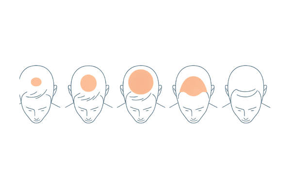 O型の進行ステージ：つむじから広がる5段階の変化