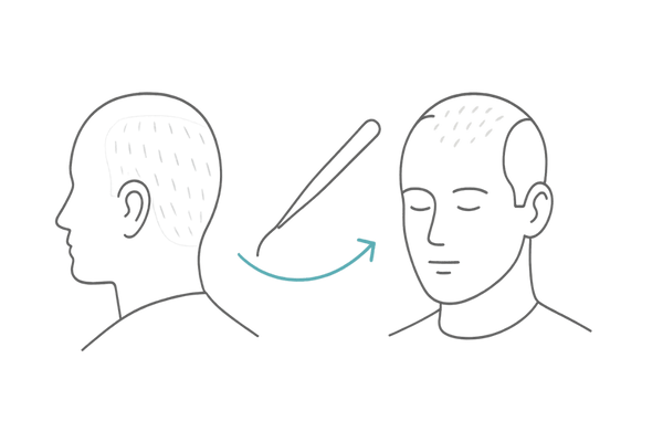 自毛植毛の基本フロー（ドナー採取から移植まで）