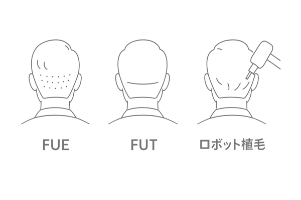 FUE・FUT・ロボット植毛の術式比較（傷跡と特徴）