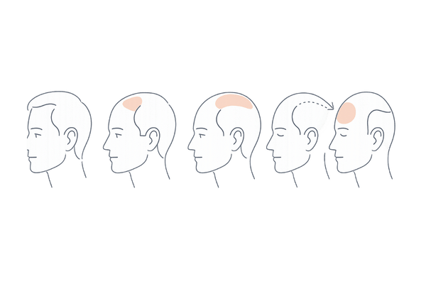 ハミルトン・ノーウッド分類の進行例（前頭部と頭頂部が結合する流れ）｜複合型AGAの重症度