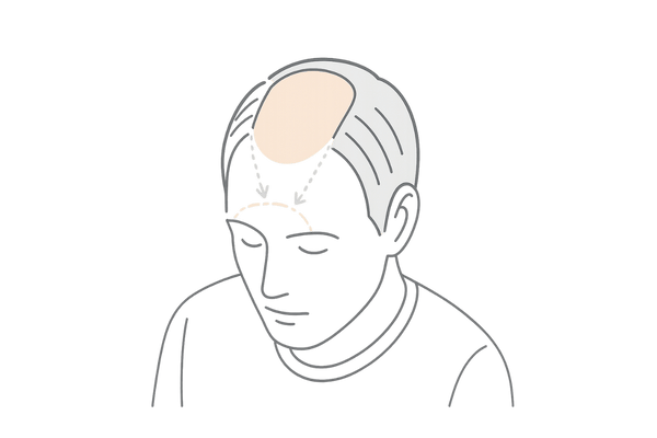 複合型（U字）進行の概念図｜前頭部と頭頂部が同時に進むケース