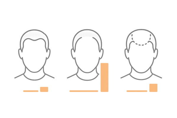 AGA進行パターン別の期待度イメージ|M字・O字・U字の比較