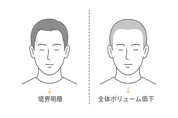 脱毛パターンの比較：境界の明瞭さとボリューム低下の違い
