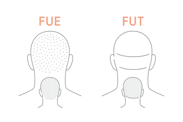 FUEとFUTの傷跡比較(点状 vs 線状)