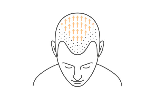 FUTによる高密度移植エリアのカバーレンジ