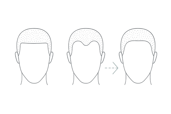 生え際デザインの選択肢：ストレート／M字／ラウンド