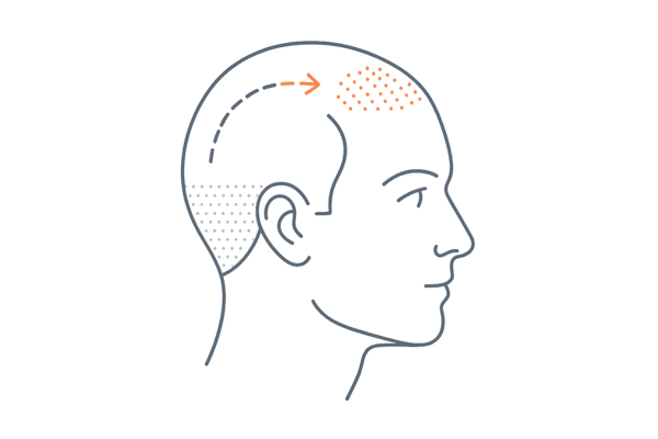 自毛植毛の基本概念図(ドナー採取から生え際・頭頂への移植フロー)