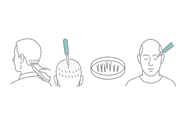 FUE植毛の施術フロー(パンチ採取から植え込み)