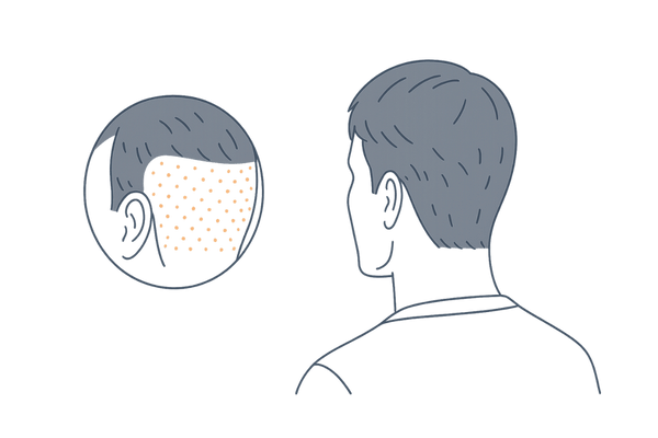 FUEの点状瘢痕と短髪スタイルの相性イメージ