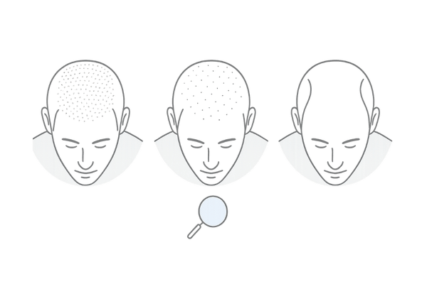 頭頂部の露出度スケール｜つむじの見え方の段階図