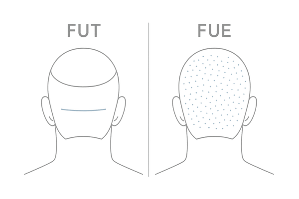 FUEとFUTの傷跡比較