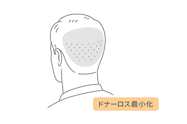 ドナーロス最小化