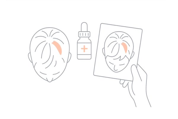 頭頂部（つむじ）の薄毛が気になる方へ